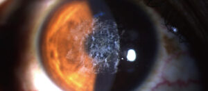 Tear Film Photo