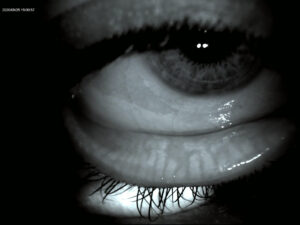meibomian gland detail photo